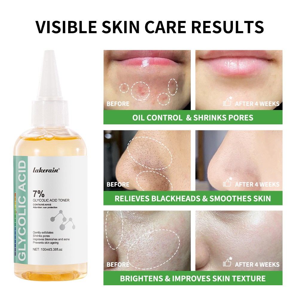 글리콜산 7% 토닝 솔루션, 일반 여드름 제거제, 리프 - Lactic Acid Toner 리뷰 및 가격